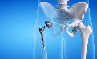 Hip Arthroscopy